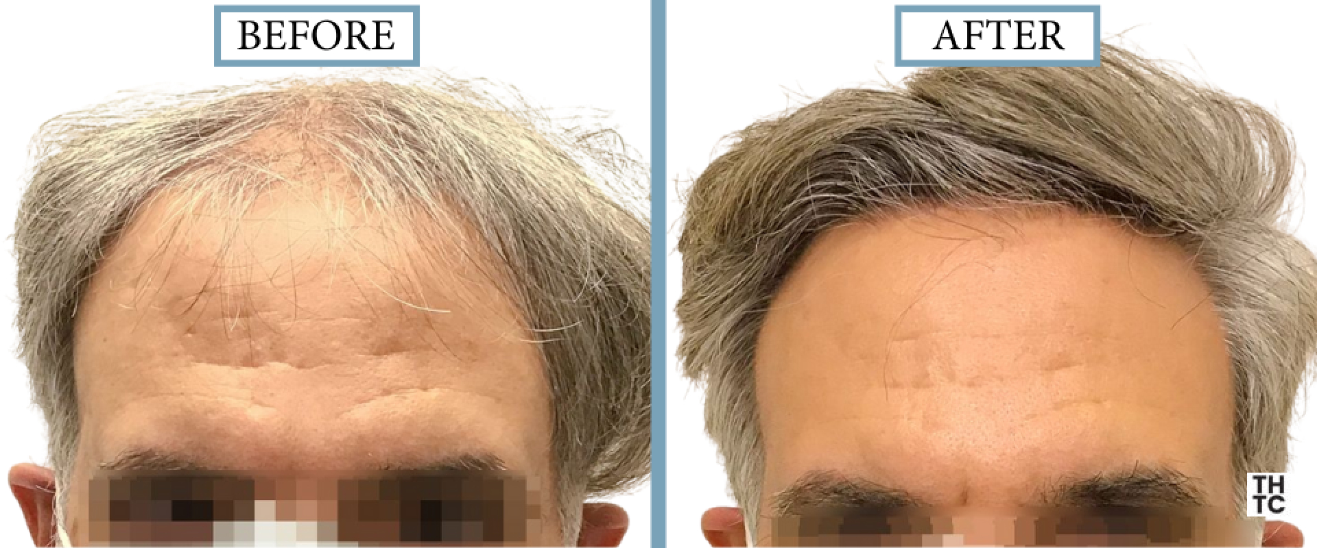 Hair Transplant Toronto
